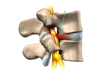 Bel Fıtığı Siyatik Belirtileri ve Tedavisi